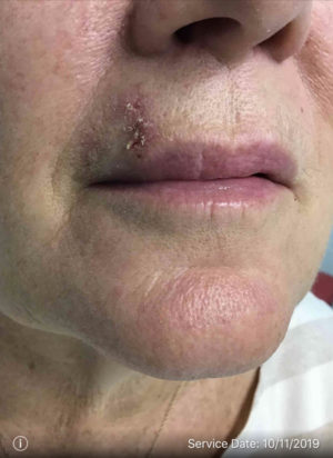 Basal Cell Carcinoma