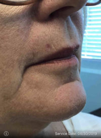 Basal Cell Carcinoma