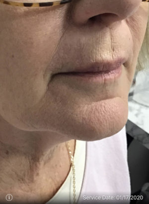 Basal Cell Carcinoma