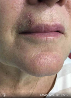 Basal Cell Carcinoma