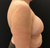 Breast Reconstruction