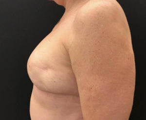 Breast Reconstruction