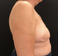 Breast Reconstruction