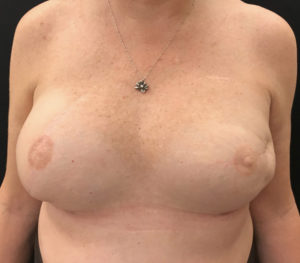 Breast Reconstruction