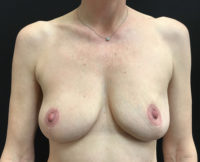 Breast Lift