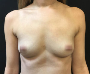 Breast Augmentation