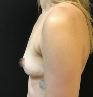 Breast Augmentation