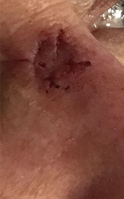 Basal Cell Carcinoma