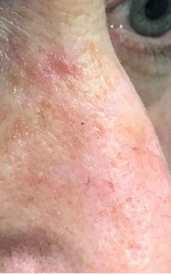 Basal Cell Carcinoma