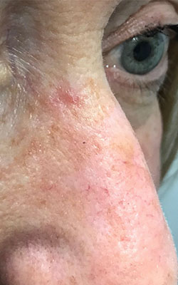 Basal Cell Carcinoma