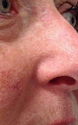 Basal Cell Carcinoma