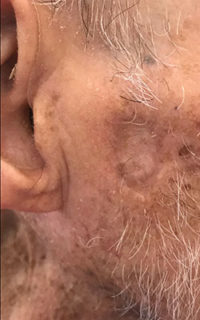 Basal Cell Carcinoma