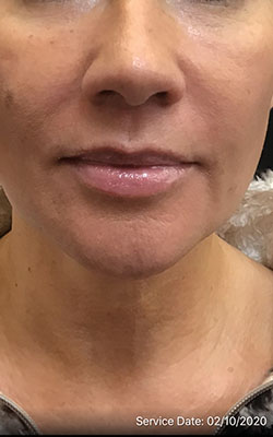 Juvederm