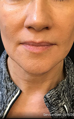 Juvederm