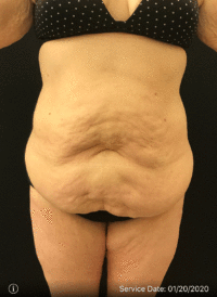 Tummy Tuck