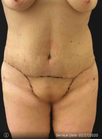 Tummy Tuck