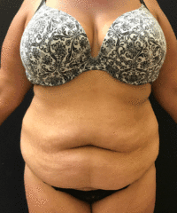 Tummy Tuck