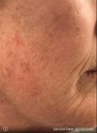 Actinic Keratoses