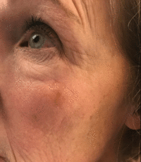 Actinic Keratoses