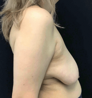 Breast Reduction