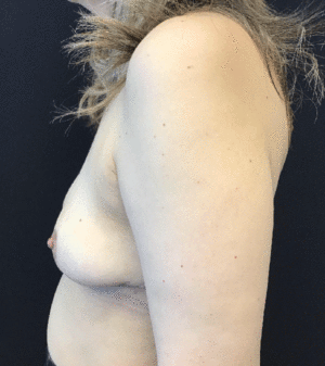 Breast Reduction