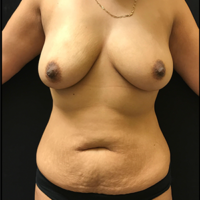 Tummy Tuck