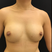 Breast Augmentation