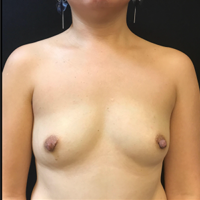 Breast Augmentation