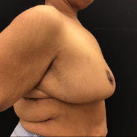 Breast Lift