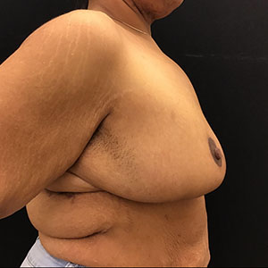 Breast Lift