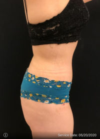 Tummy Tuck