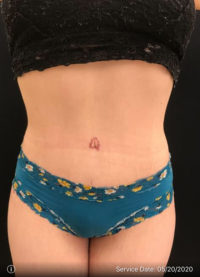 Tummy Tuck