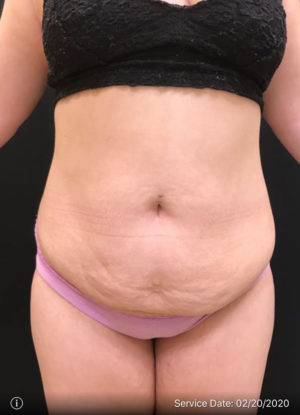 Tummy Tuck