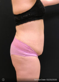 Tummy Tuck