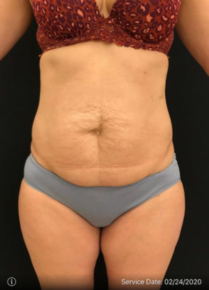 Tummy Tuck