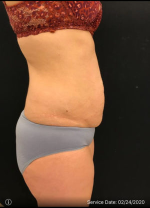 Tummy Tuck