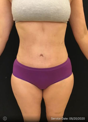 Tummy Tuck