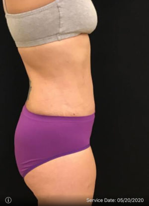 Tummy Tuck