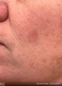 Actinic Keratoses