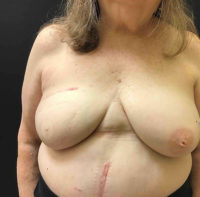 Breast Reconstruction