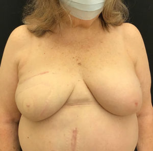 Breast Reconstruction