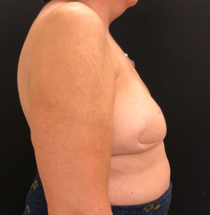 Breast Reconstruction