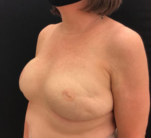 Breast Reconstruction