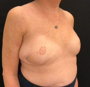 Breast Reconstruction