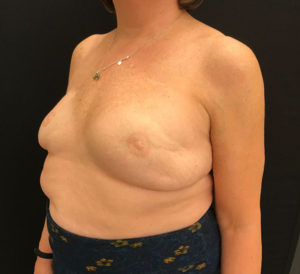 Breast Reconstruction