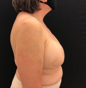 Breast Reconstruction