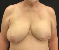 Breast Reconstruction