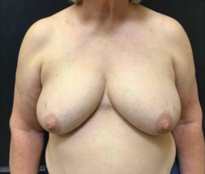 Breast Reconstruction