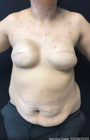 Breast Reconstruction