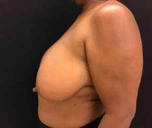 Breast Reduction